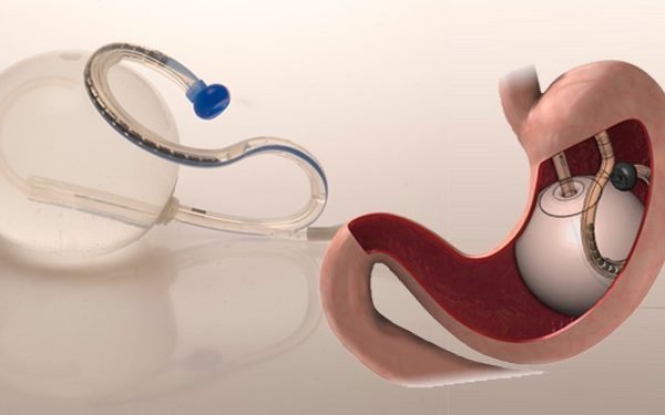 The Shape of Wellness Exploring Stomach Balloon Surgery in Dubai